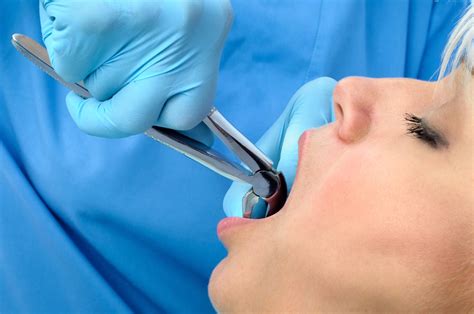 Image result for Tooth Extraction Procedure