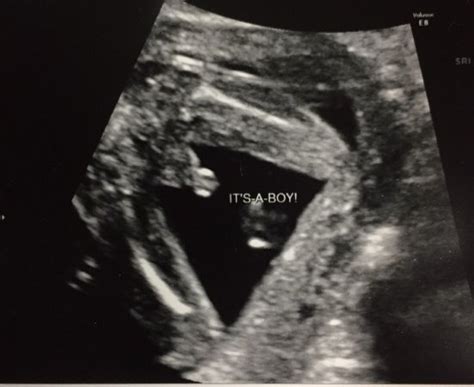Penis or umbilical cord? | BabyCenter