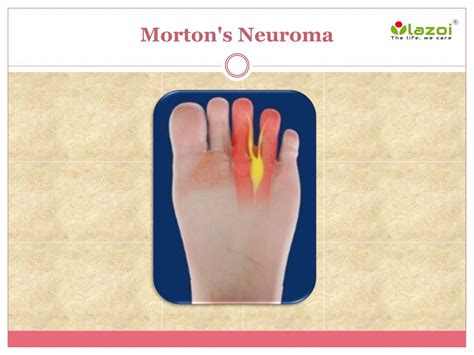 PPT - Mortonâ€™s Neuroma: Causes, Symptoms, Daignosis, Prevention and Treatment PowerPoint ...