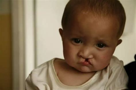 Putting Their Smile Back Together - Pune Doctor Performs Free Cleft ...