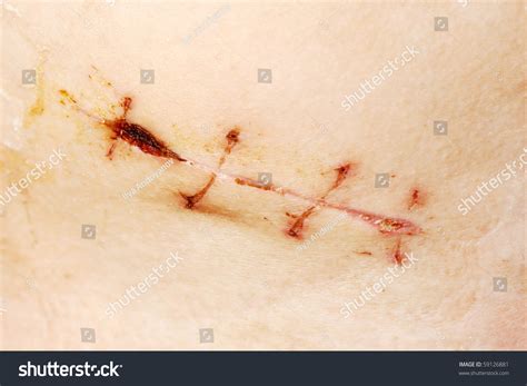 Image result for Appendix Surgery Scar