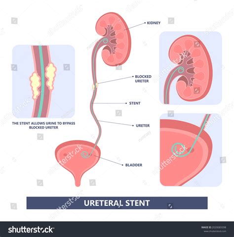 Stent For Kidney Stones