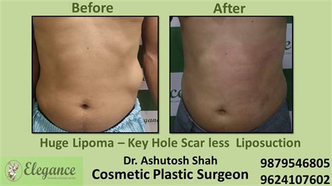 Swelling Reduction from Body Treatment in Surat, Gujarat