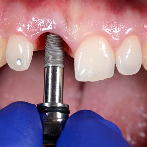 Pros and Cons of Dental Implants!