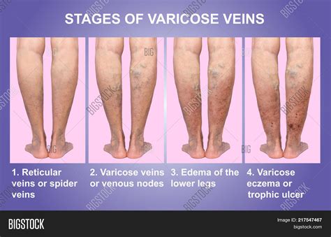 Varicose Veins On Image & Photo (Free Trial) | Bigstock