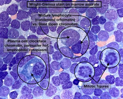 Morphologic features of Acute Lymphoblastic Leukemia (B-ALL) involving ...
