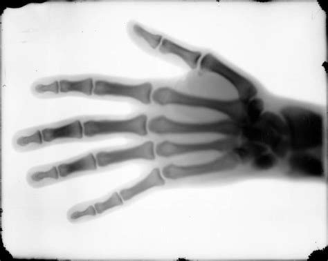 Image result for Alien Hand Syndrome Documentary