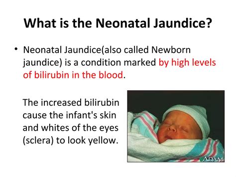 Image result for Neonatal Jaundice Algorithm