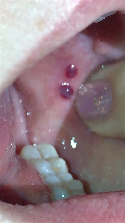 Blood Blister In Mouth