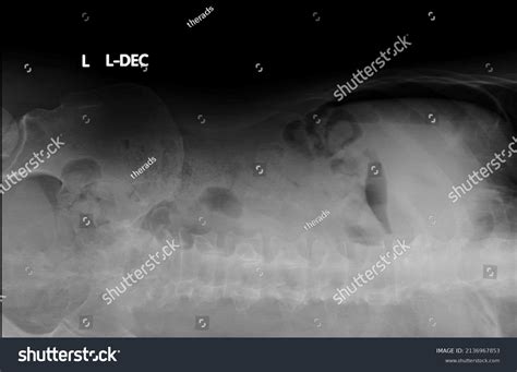 Table 2 From Lateral Decubitus Chest Radiography Or Chest Ultrasound Tolateral Decubitus Pleural