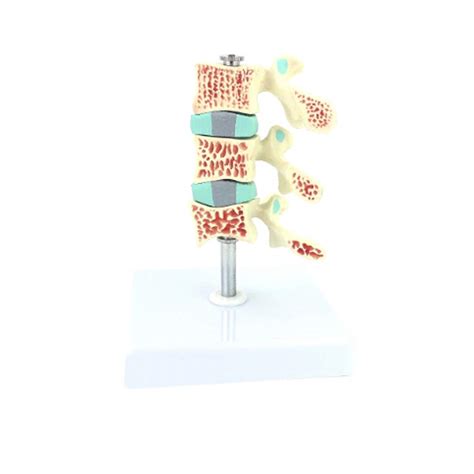 Buy Osteoporosis Model 3 Vertebrae - Anatomy Human Skeleton ...