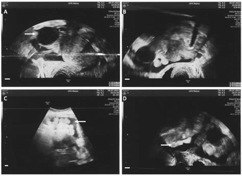 Abdominal B-Cell Lymphoma Mimicking Ovarian Cancer