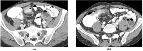 Comprehensive Imaging Evaluation and Staging of Crohn’s Disease: When ...