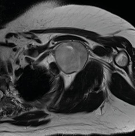 Periphere Nervenscheidentumoren - Plastische Chirurgie - Universimed ...