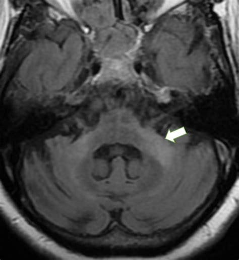 Cerebral Peduncle Mri