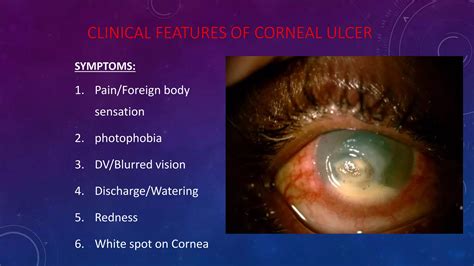 Bacterial corneal ulcers.pptx