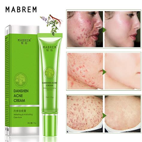 Ediodpoh Korean Beauty Acne Treatment Cream - Removes Scars & India | Ubuy