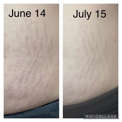 Cream Benefits For Stretch Marks at Lori Allan blog
