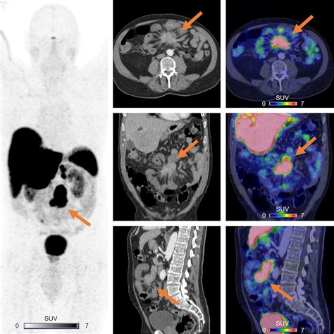 Outcome on Mesenteric Mass Response of Small-Intestinal Neuroendocrine Tumors Treated by 177Lu ...