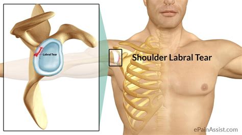 SHOULDER LABRAL TEAR - MOTUS Physical Therapy