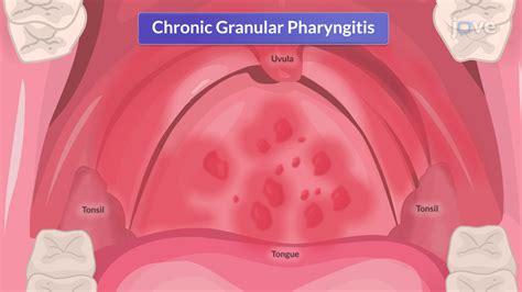 Video: Chronic Pharyngitis