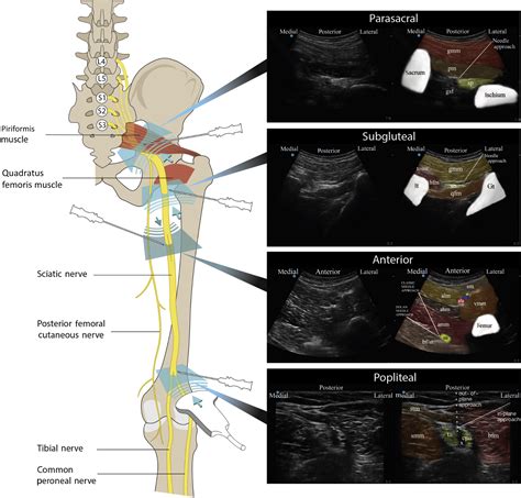 The sciatic nerve block - BJA Education