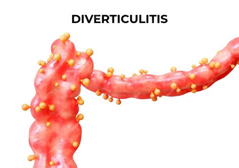 Premium Photo | Diverticulitis is a disease that occurs when the ...