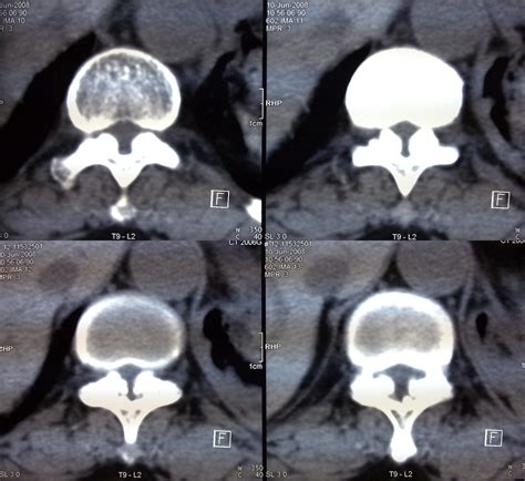 Facet Joint Hypertrophy Mri at Marcus Hanger blog