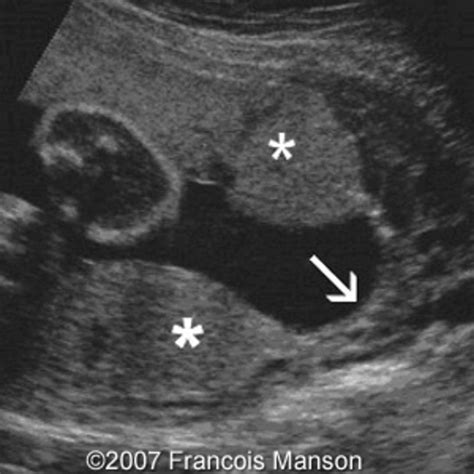 Imagens Anormais De Ultrassom Da Placenta