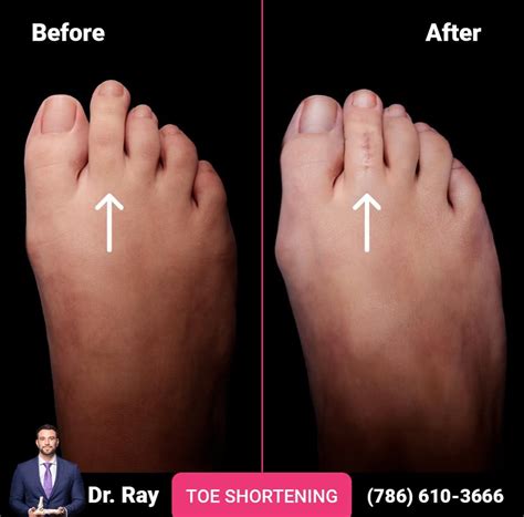 Image result for Toe Surgery