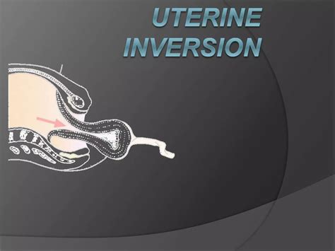 Inversion of uterus-170225210149-converted.pptx
