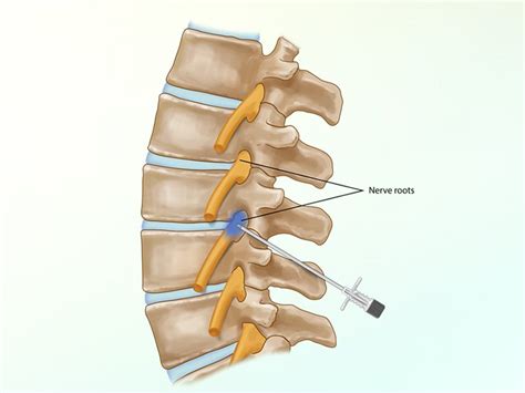 Image result for Fluoro Spinal Injection