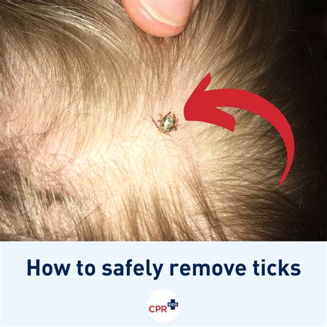 Do you know the safest way to remove a tick from your child (or yourself)? | CPR Kids
