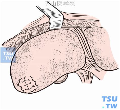 【附图】 肝部分切除术 _外科手术学 | 天山医学院