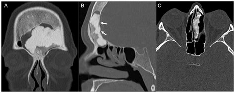 Imaging of Skull Base Tumors