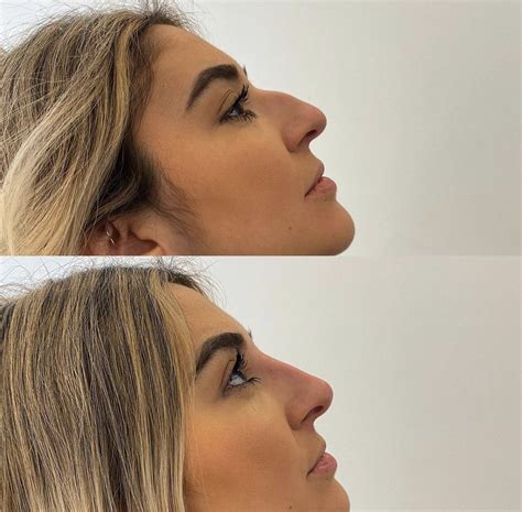 Non surgical rhinoplasty | Rinoplastia, Cirugias de nariz, Nariz perfecta