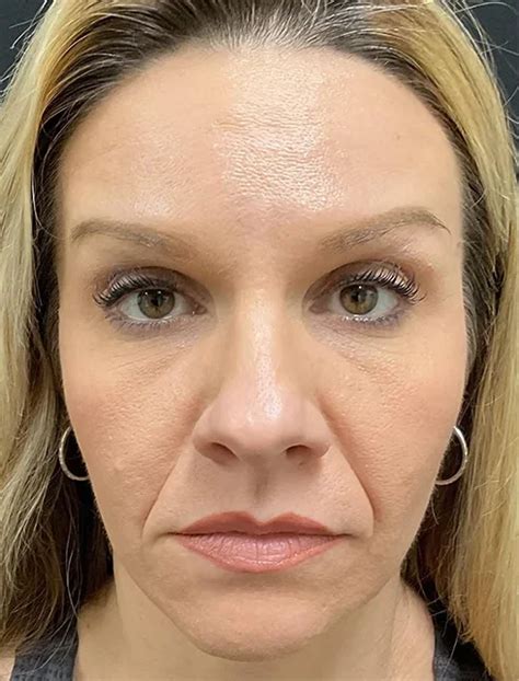 Image result for Botox Examples