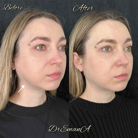 Masseter Botox Transform Your Jawline: Masseter Botox Benefits