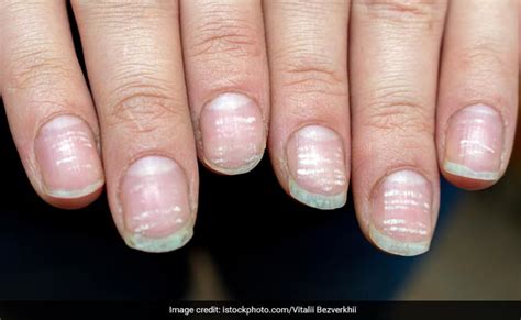 इस वजह से नाखूनों पर दिखने लगते हैं सफेद निशान, जानिए कैसे पाएं इस ...