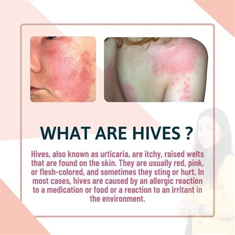 What are hives? | Allergic reaction on skin, Allergic reaction, Hives