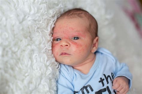 Treatment and Help for Baby Acne - Super Healthy Kids