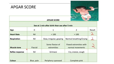 Image result for Apgar Score Example