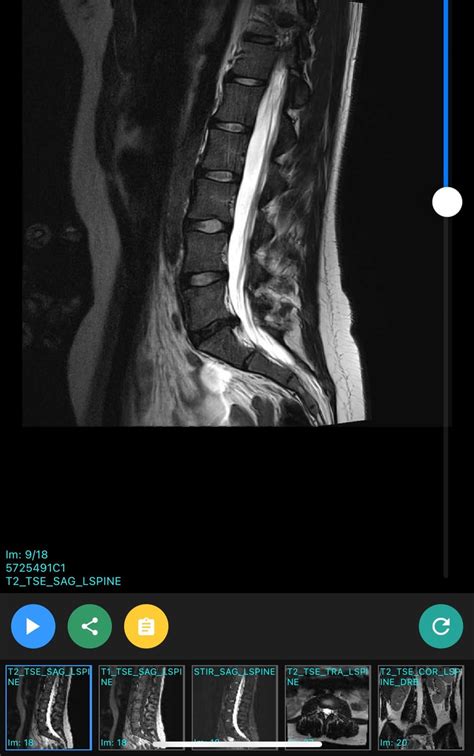 L5/1 grade 1 retrolisthesis, annular fissure and a broad-based disc ...