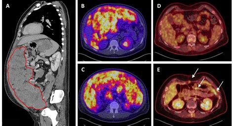 Desmoplastic Small Round Cell Tumors: A review with focus on clinical ...