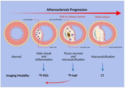 PET-Based Imaging in Atherosclerosis | Encyclopedia MDPI