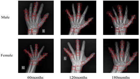 Automated Bone Age Assessment: A New Three-Stage Assessment Method from ...