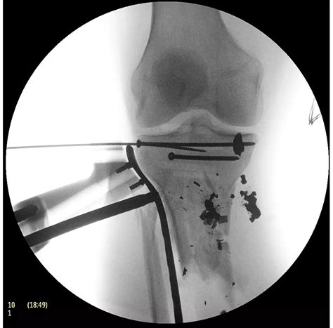 Philips - Zenition 50 - Mobile C-arm with Image Intensifier