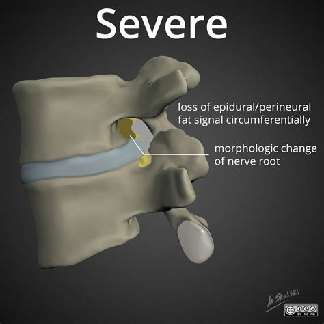 What Is Foraminal Narrowing Mean at Milla East blog
