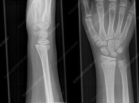 Image result for Fractured Radius
