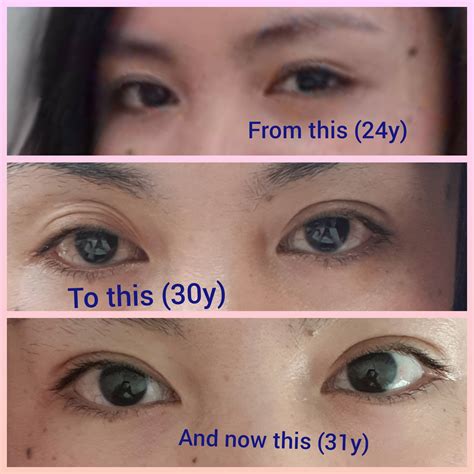 How To Fix Uneven Eyelids